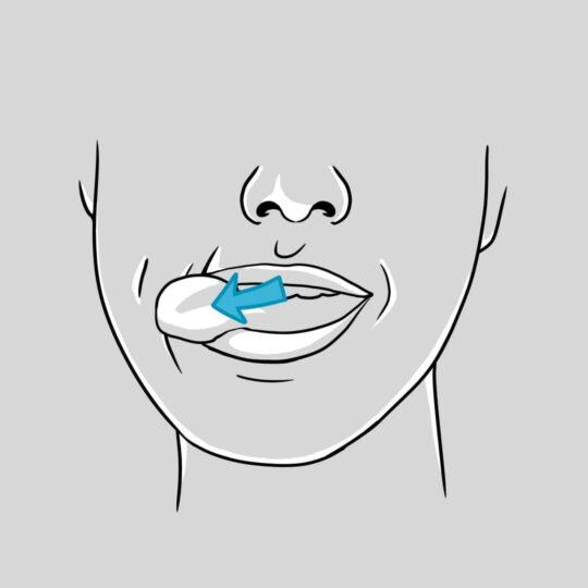 Myofunctional Therapy used to improve sleep apnea and chronic snoring