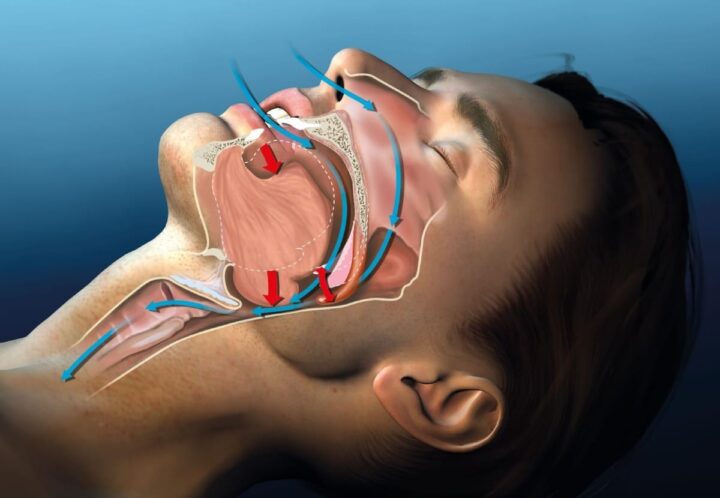 MIPS to reduce snoring MIPS to reduce snoring