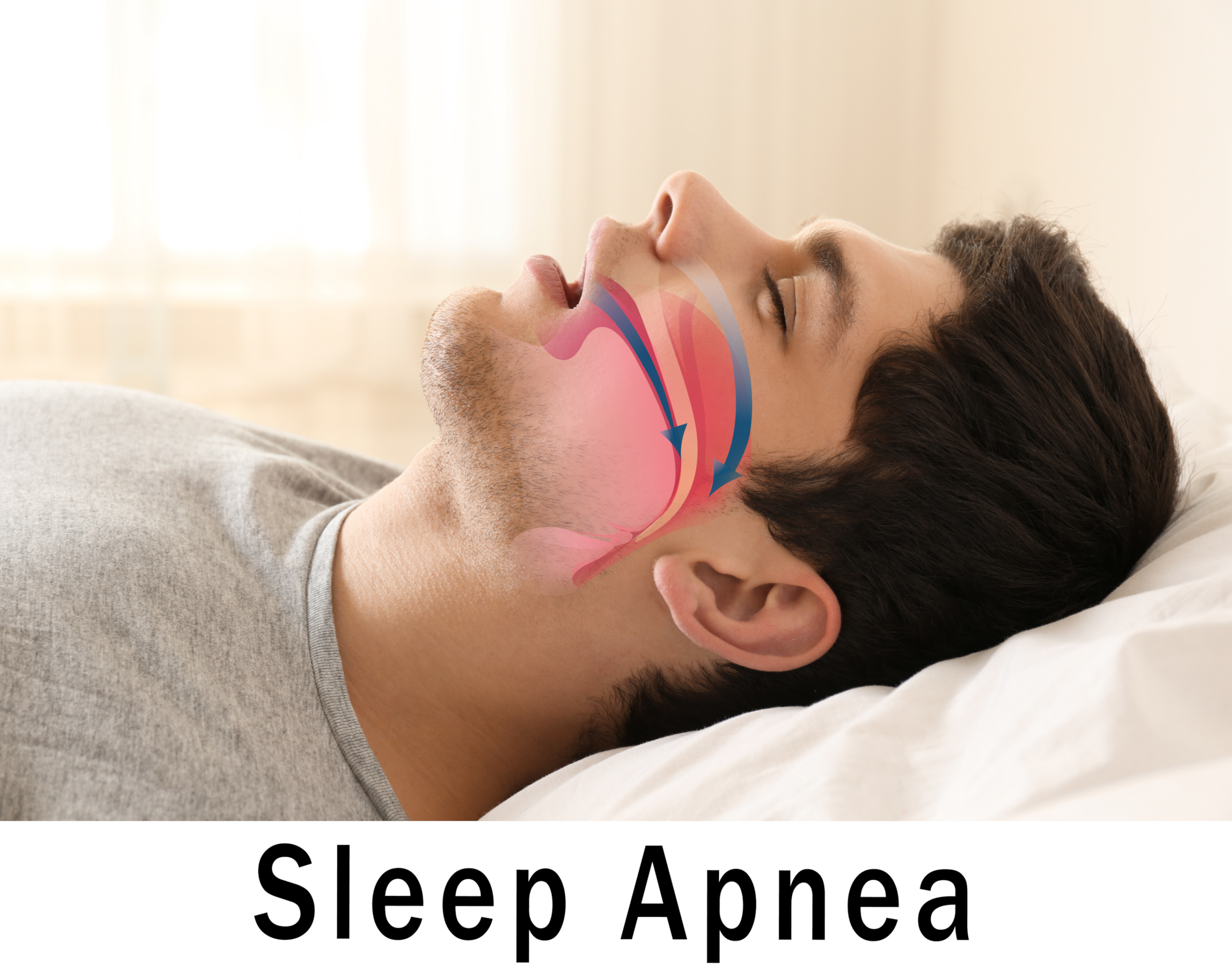 sleep apnea fort lauderdale