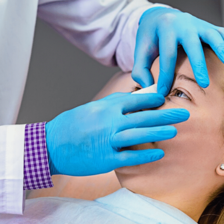 balloon sinuplasty