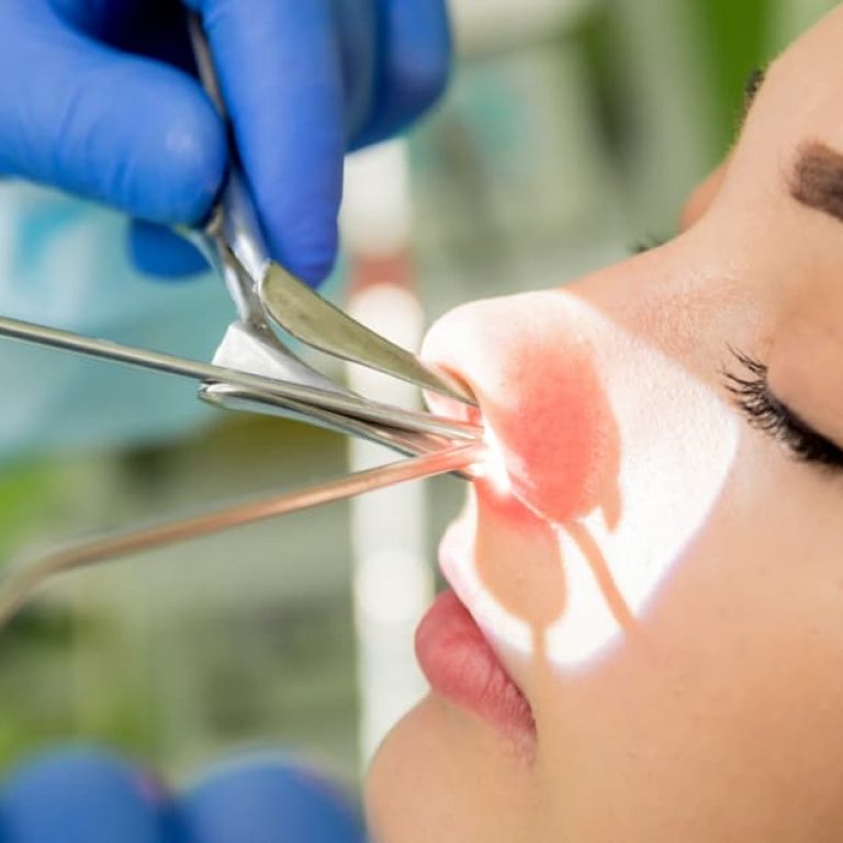 vivaer procedure